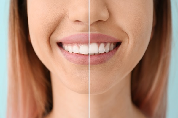 Advantages of Gum Contouring