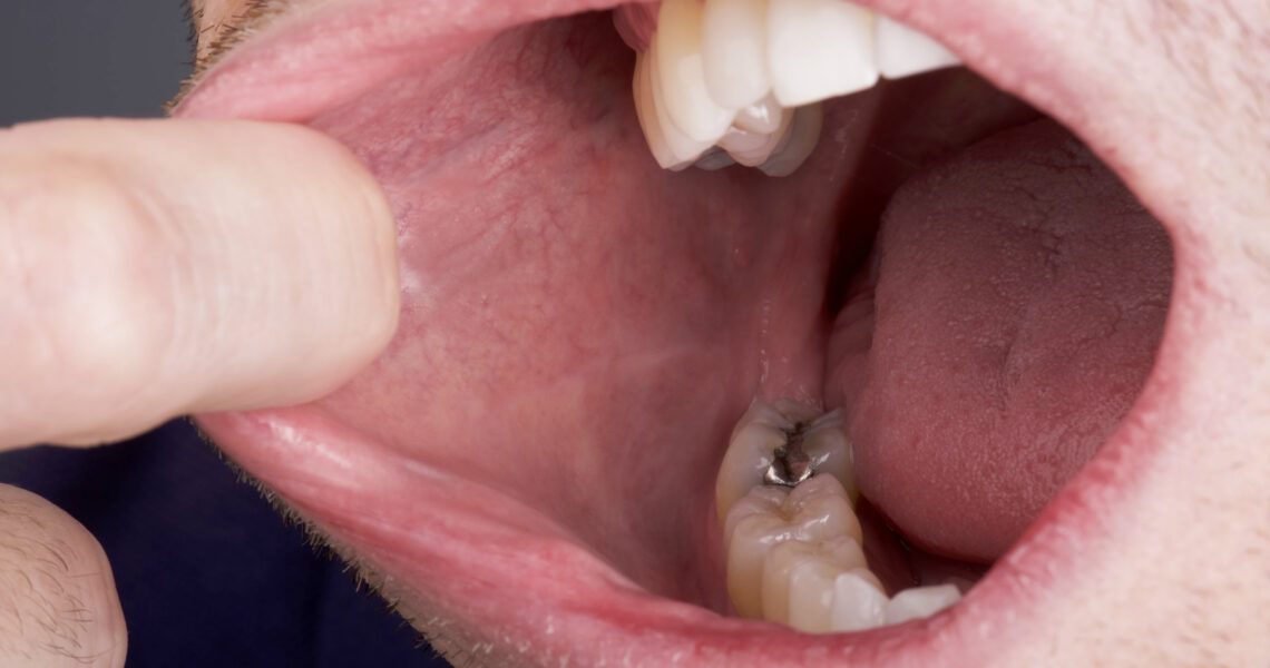 The Ideal Nutritional Plan to Avoid Oral Cancer